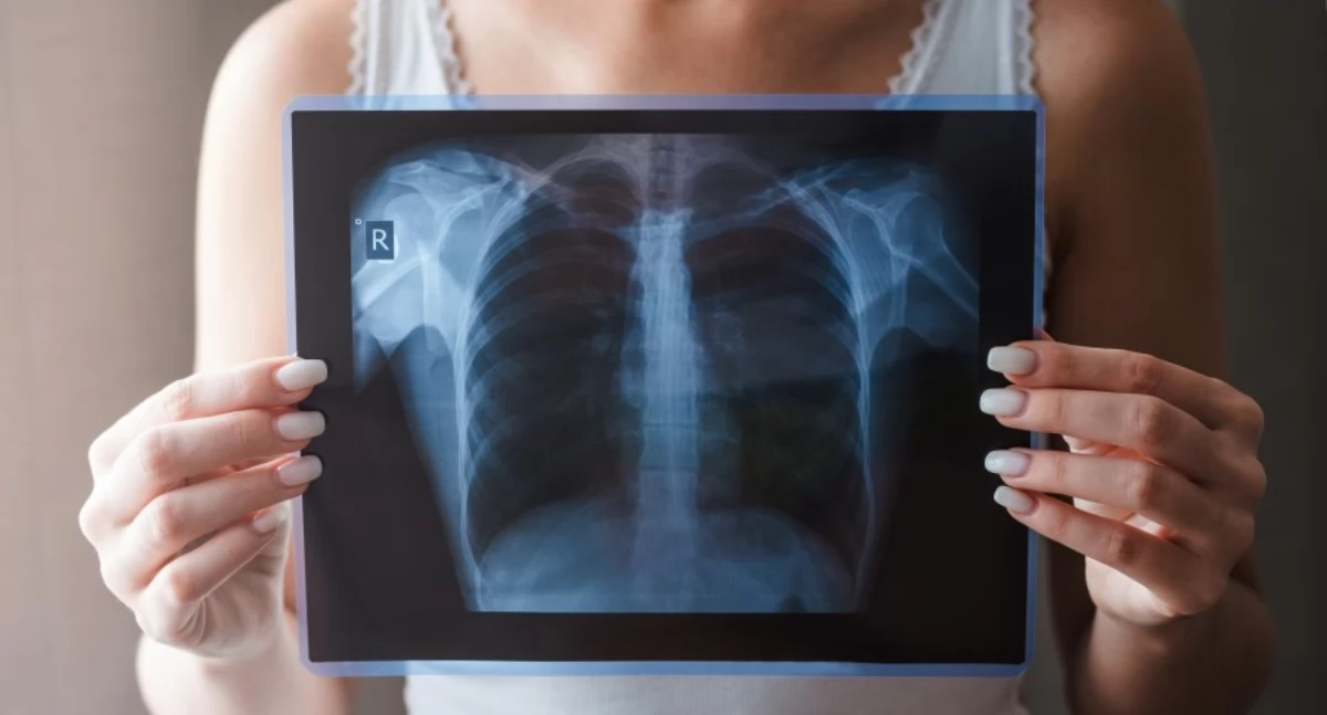 zdrowie, zdrowie płuc skorzystaj bezpłatnej tomografii Białej Podlaskiej! - zdjęcie, fotografia